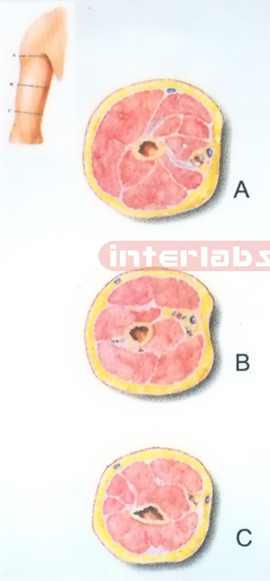 HANGING HUMAN TRANSVERSE SECTION THROUGH THE MIDDLE 1/3 OF THE RIGHT ARM (A, B, C)